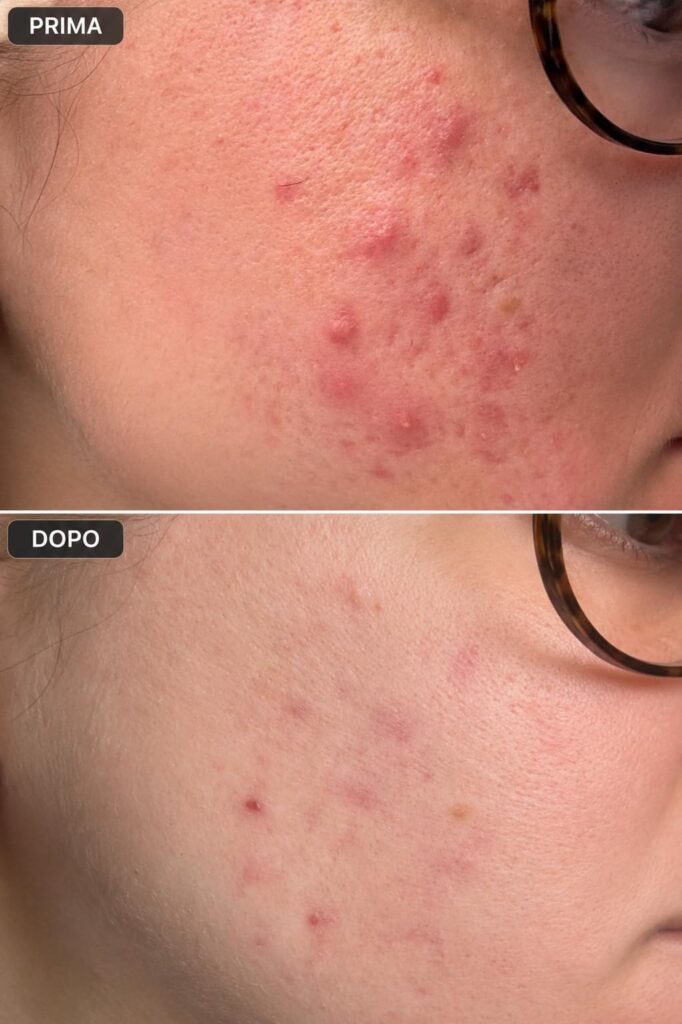 Infographie avant-après de l'effet du produit sur l'acné, visage de femme